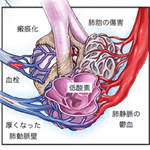 肺高血圧症