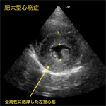 心筋症の診断について